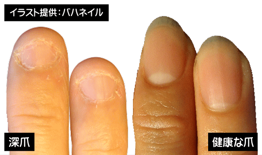 深爪と健康な自爪