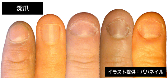 深爪の症状の違い