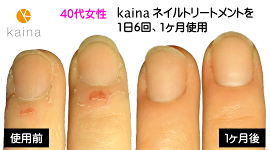 深爪を健康な自爪に治すならカイナ